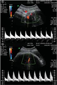 color doppler ultrasound examination of the vertebral upper