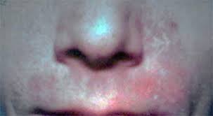 Seborrhoisches Ekzem Rosacea Fehldiagnose Cyberdoktor Patientenberatung