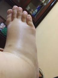 Insufisiensi vena merupakan kondisi di mana darah tidak dapat naik dari terlalu lama berdiri juga bisa menyebabkan kaki sebelah kanan bengkak. 37w Kaki Super Bengkak Mr Mrs Aditya