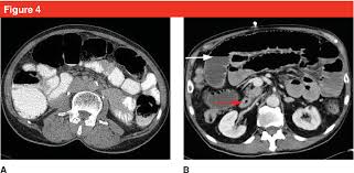 Image result for Adynamic Ileus