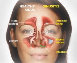 Image result for Rhinosinusitis