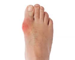 Gout pain is a kind of arthritis created as a result of high uric acid degrees in the body. Gout And Low Carb Diet Doctor