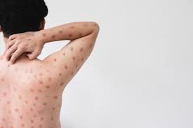 Image result for Erythema Multiforme