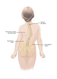 scoliosis scoliosis boston children s hospital back injury