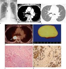 Pleural effusion may be a symptom of mesothelioma, lung cancer or other diseases. Pleural Localized Malignant Mesothelioma Mimicking A Benign Solitary Fibrous Tumor Of The Pleura On Chest Computed Tomography A Case Report