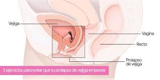 Prolapso De Vejiga Tratamientos Naturales Para Su Recuperacion