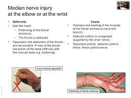 Assessing for nerve injuries in children is often difficult compared to examining skeletally mature individuals. Applied Anatomy Median Nerve Injury