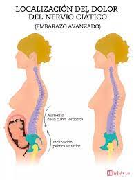 Ciatica En El Embarazo Causas Y Formas De Aliviar El Dolor Mi Bebe Y Yo