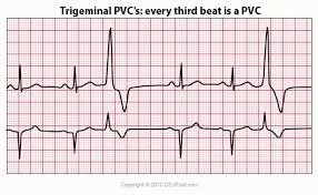 Pvc interpolated by the eccles health sciences library is licensed under the creative. Ekg Ecg Interpretation Course Ceufast Nursing Continuing Education