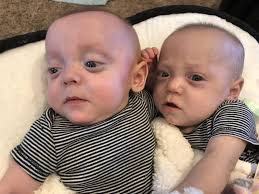 Just wanted to pop in for Olivia's 8th birthday! Former 24-weeker is still  doing amazing. She's now graduated from cardiology and pulmonology as well!  🎉🎉🎉