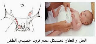 علاج كيس المياء علي الخصيتين عند الاطفال