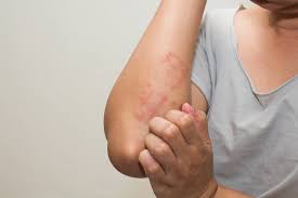 Image result for scabies effects on the human body