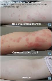 Image result for Erythema Multiforme Causes