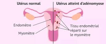 Das hauptmerkmal der adenomyose ist, dass das endometrium nur im myometrium (mittlere schicht des uterus) wächst und nicht über seine grenzen hinausragt, das heißt, es infiziert keine. Uterus Normal Vs Uterus Atteint D Adenomyose Docteur Majid Benjelloun Gynecologue Facebook