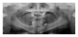 Phenotypic Features and Salivary Parameters in Patients with Ectodermal  Dysplasia: Report of Three Cases