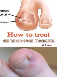 Maybe you would like to learn more about one of these? 10 Ingrown Toe Nail Ideas Ingrown Toe Nail Toe Nails Feet Care