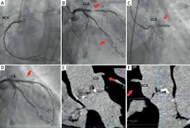 Create er diagram online within seconds. Easy Access To The Coronary Arteries After Evolut R 26 Valve Implantation Download Scientific Diagram