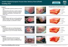 Image Result For Pressure Sore Grading Pressure Ulcer Wound Care Pressure Ulcer Staging