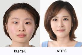 All About Korean Plastic Surgery Korean Plastic Surgery Makeup Before And After Plastic Surgery