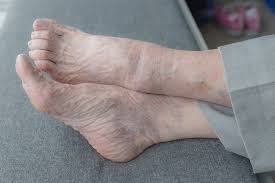 Image result for Onychogryphosis feet