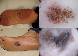 Melanoma is one of the deadliest skin cancers and survival. Acral Lentiginous Melanoma In Situ Dermoscopic Features And Management Strategy Scientific Reports