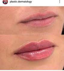 Pin By Ashley Quinton On Lips Inspiration In 2021 Lips Inspiration Dermal Fillers Lips Botox Lips