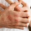 Reazioni cutanee come orticaria o eczema conj congiuntivite allergica: 1