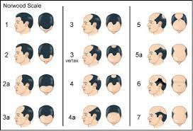 Conclusion so, thin hair can be caused by stress or bad lifestyle, often temporary, and can be treated by erasing the cause. What S The Difference Between Balding And Just Having A Mature Hairline What Is The Clue That It S Legit Balding Quora