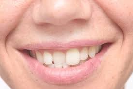 Crooked teeth look terrible on both adults and children. What Are The Best Treatment Options For My Crooked Teeth Unique Orthodontics