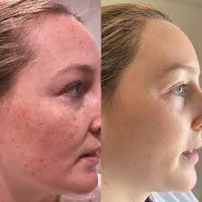 Lumecca IPL Results Lumecca is the most powerful intense pulsed light (IPL)  to treat colour changes in the skin ie brown spots like freckles and  pigmentaion from sun damage and also red
