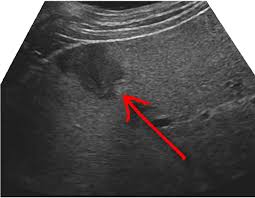 Pin On Ultrasound Sonography