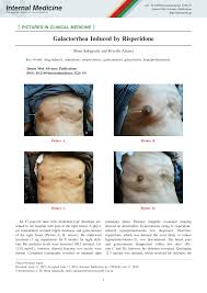 Image result for Galactorrhea