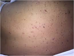 Treatment xanthomas may go away on their own. Eruptive Xanthoma In The Setting Of Hypertriglyceridemia And Pancreatitis The American Journal Of Emergency Medicine