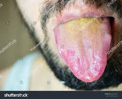 Image result for yellow tongue infection