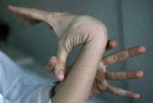 Marfan Syndrome Physiopedia