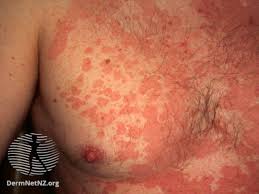 Treatment of tinea versicolor can consist of creams, lotions, or shampoos that you put on your skin. Best Treatments For Tinea Versicolor Skin Infection