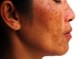 Image result for Melasma calycinum