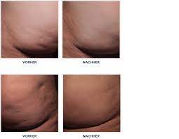 Erfahre hier ganz genau wie du vorgehen musst, um deine cellulite für immer du kannst deine cellulite jetzt auf natürliche weise loswerden, wenn du richtig vorgehst! Cellulite Loswerden So Funktioniert Es Merzbeauties