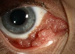 Image result for human papillomavirus symptoms