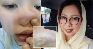 Cara menghilangkan komedo dengan cepat, cara mengeluarkan blackhead, cara menghilangkan blackhead di pipi, cara menghilangkan blackhead harap dicatat, obat cara menghilangkan komedo blackhead dengan cepat ini bekerja lebih baik pada orang yang memiliki kulit kering. Ini Sebabnya Kenapa Kita Kena Buang Blackhead Dan Whitehead Kartel Dakwah