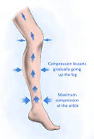 Compression Garments For Lipedema