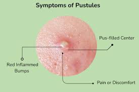 Image result for Pustule