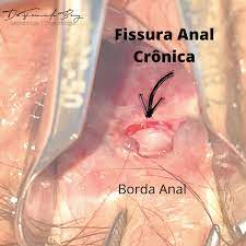 O Que E Fissura Anal Sintomas E Tratamentos Dr Fernando Bray
