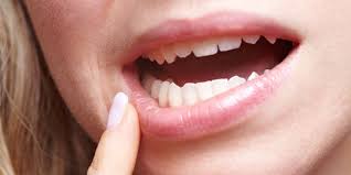 Nah itulah penjelasan tentang ruam merah setelah demam pada bayi yang harus dipahami. Atasi Virus Herpes Di Mulut Dengan 8 Cara Mudah Ini Merdeka Com