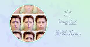Bell's palsy affects one side of the face. Measuring Your Recovery Progress After Bell S Palsy Crystal Touch Bell S Palsy Clinic