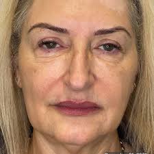 TriBella™ Treatments in Langley