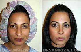 Facial Plastic Surgeon NYC