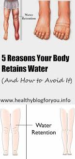 Water Retention Or Fluid Retention Is The Excessive Accumulation Of Fluids In The Circulatory System Body Tissues In 2020 Body Tissues Fluid Retention Water Retention