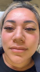 whispy volume 0.05CC 9-13/12-17