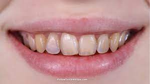 Pin On Yellow Teeth